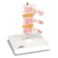 Modell Osteoporose
