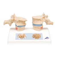 Modell Osteoperose