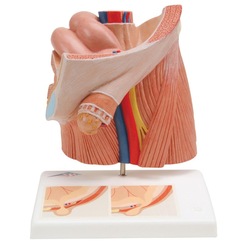Leistenbruch (hernia), anatomische dds