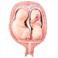 Uterus mit Zwillingen - 5. Monat