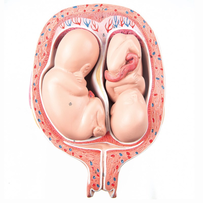 Uterus mit Zwillingen - 5. Monat