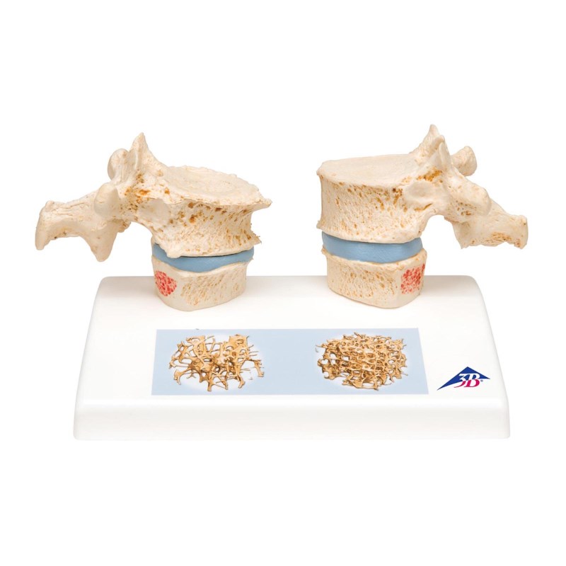 Model Osteoperose